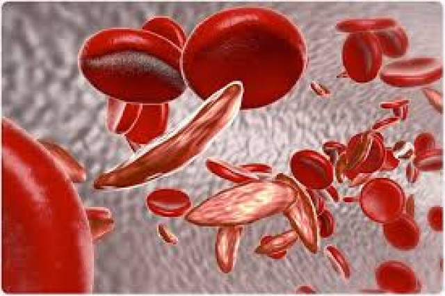 Picture of Sickle Cell Anaemia